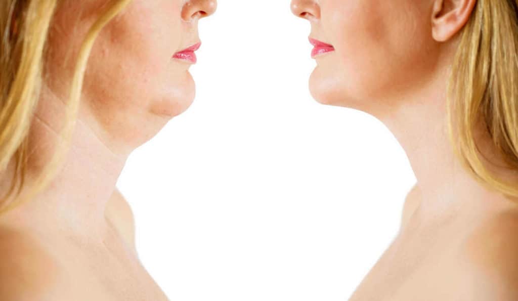 Double Chin treatment The Potteries before and after results