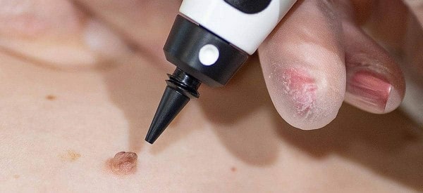 After Skin Tag Removal The Potteries
