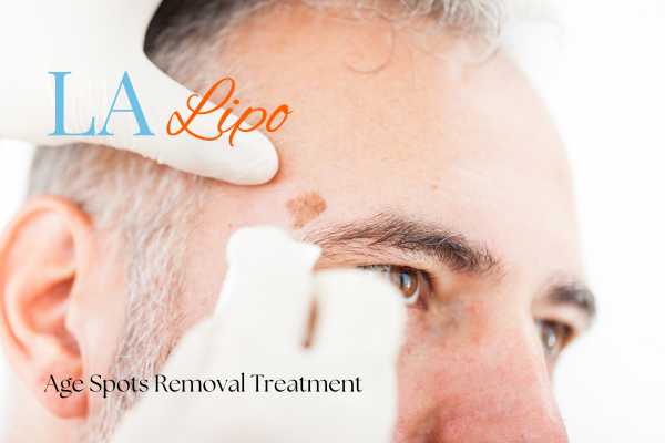 What Are the Most Effective Treatments for Age Spots The Potteries?