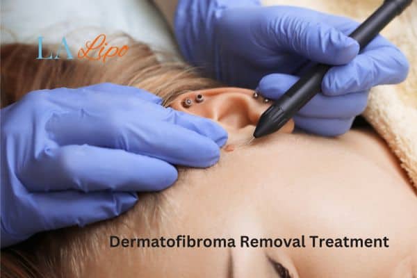 Dermatofibroma Removal Treatment The Potteries