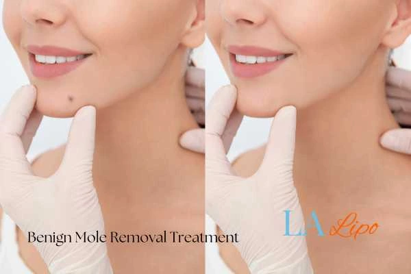 Before-and-after results following benign mole-removal treatment The Potteries