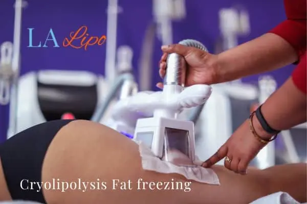 women getting fat freezing The Potteries