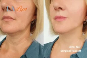 hi-fu for wrinkles The Potteries before and after results