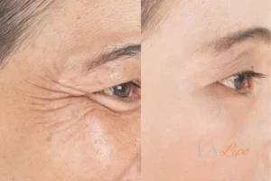 Before and after results of woman - HI-fu wrinkles reduction treatment The Potteries