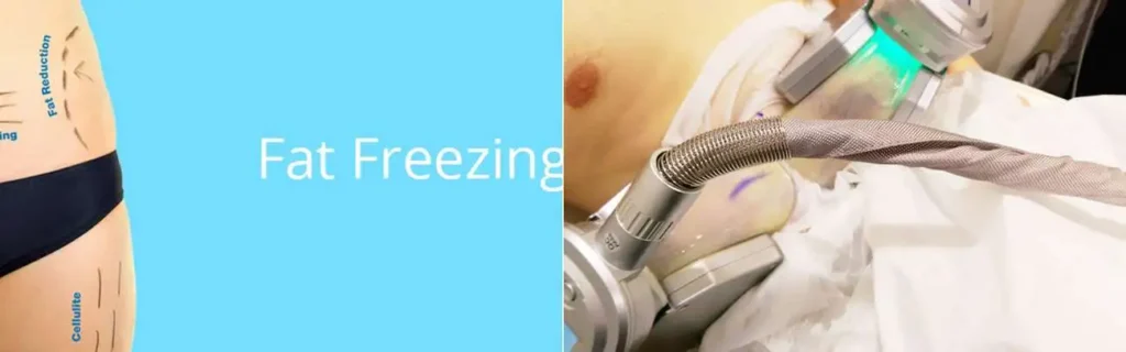 Fat freezing The Potteries on multiple areas of the body