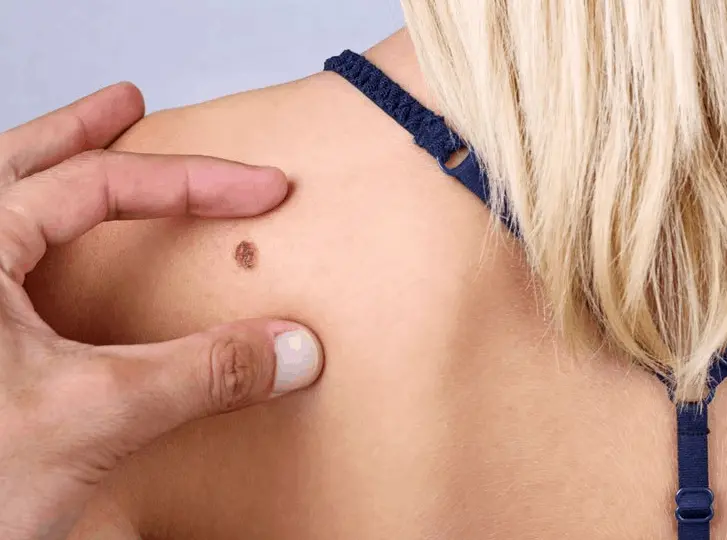 woman having mole removal The Potteries consultation before treatment.