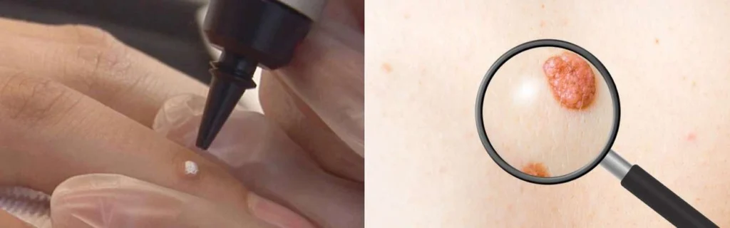 CryoPen practitioner The Potteries assessing a benign mole before treatment