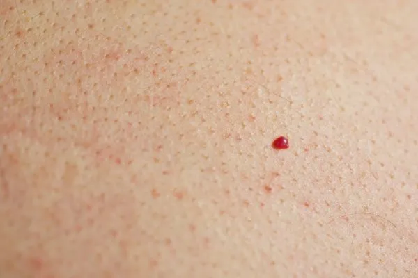 close up of a cherry angioma The Potteries