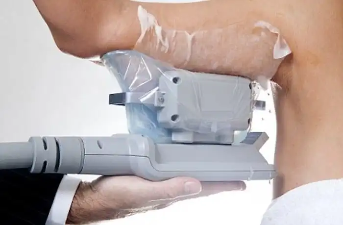 Picture of fat freezing The Potteries on the upper arms.