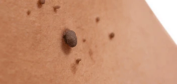 image of a skin tag The Potteries