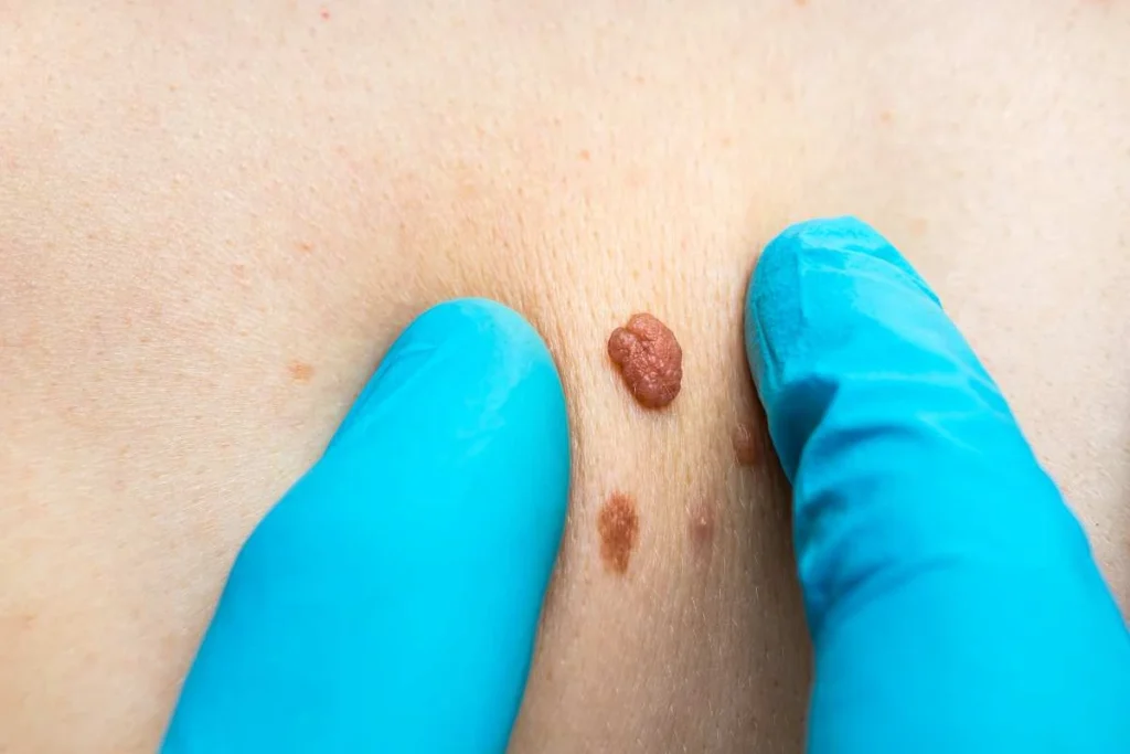 Consultant examining a skin tag The Potteries