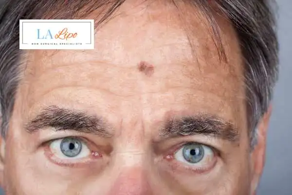Solar Lentigo Removal The Potteries image of man with mark on his forehead