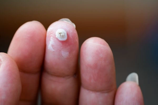 wart on person finger - cryotherapy to treat from LA LIPO The Potteries