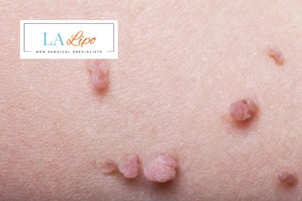 Does cryopen skin tag removal The Potteries hurt? Find out now call our team today!