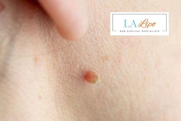 Book skin tag removal The Potteries today speak to our team now!
