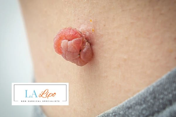 Interested in skin tag removal The Potteries? Concerned about the pain? Find out more today!