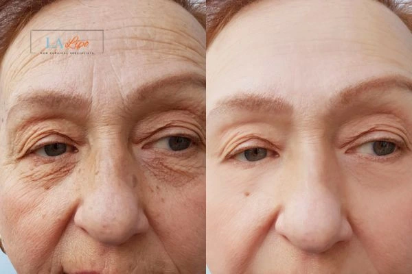 The powerful benefits of Morpheus8 Treatment The Potteries - Call Our team today!