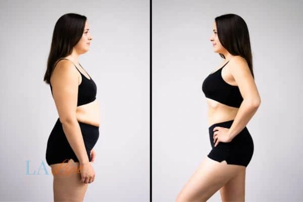 Picture of womans before and after using LA-EMS body sculpting to improve her core strength The Potteries