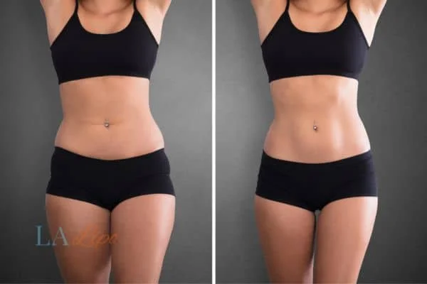 before and after results of non-surgical treatment to help a woman's body image and mental health The Potteries