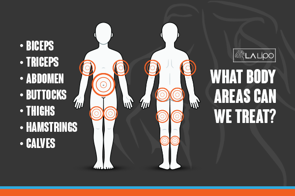 Diagram to show areas you can have LA-EMS Body Sculpting Treatment The Potteries