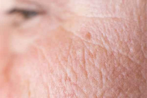 close up picture of a woman's face showing an age spot The Potteries