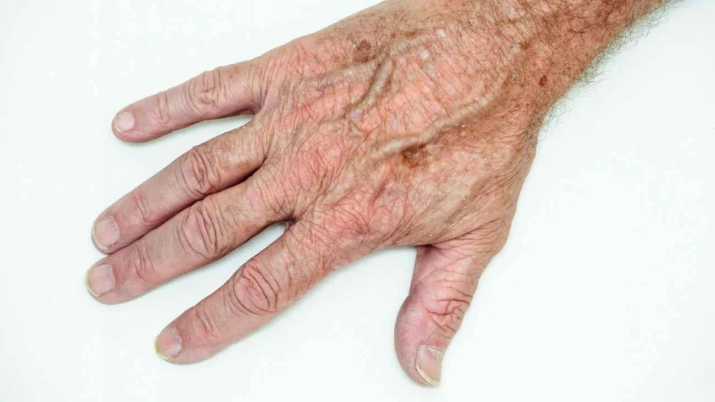 Male hand showing age spot The Potteries