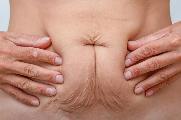 Should I Combine Diastasis Recti Treatment with Body Contouring for Better Results The Potteries?