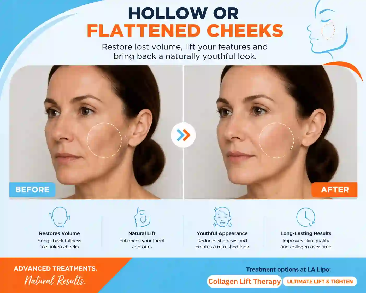 Sign #4: Hollow or Flattened Cheeks The Potteries