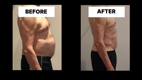 What Symptoms Can Diastasis Recti Cause in Men? Weak Core, Back Pain and Poor Posture The Potteries